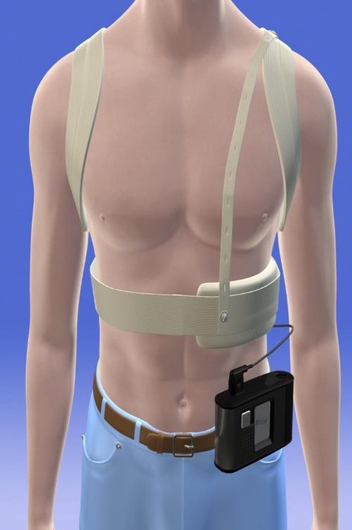 WCD (LifeVest, ZOLL, Pittsburg,PA) Technical aspects Wearable