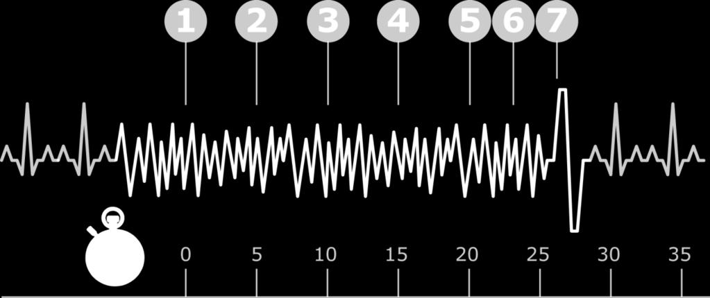 Alarm Sequence 1. Arrhythmia detected, activating vibration alert (continues throughout sequence). 2. Siren alerts begin (continues throughout sequence). 3.