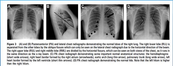 of surfactant with sighs, prone positioning Limited diagnostic accuracy of portable AP CXR in ICU to detect lobar