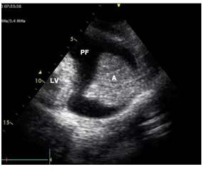Journal 4:1 16 yo male heart failure VA ECMO CXR Complete opacification? Effusion?