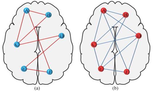 12 Fig. 13. Schematic diagraph of brain networks. (a) Typical connectivity in a control subject. (b) Typical overconnectivity in a subject with autism.