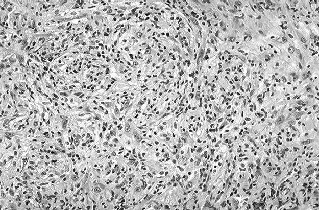 D.G. Guinee, Jr. and W.D. Travis 573 Figure 37.14. Lymphohistiocytoid mesothelioma. Histiocytoid cells with a prominent chronic inflammatory infiltrate superficially resembling lymphoma.