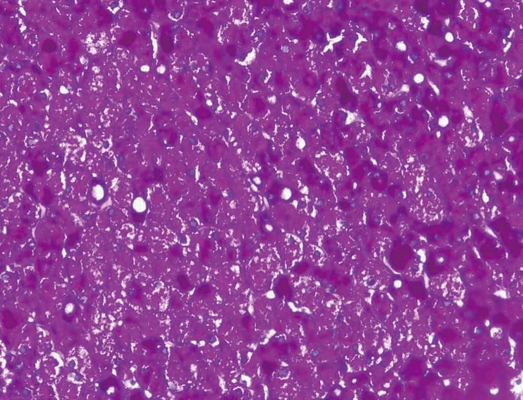 Julián MT et al. Hepatic glycogenosis in uncontrolled diabetes A B Figure 3 Liver biopsy, periodic acid-schiff staining. A: Periodic acid-schiff (PAS) demonstrates abundant cytoplasmic deposits.