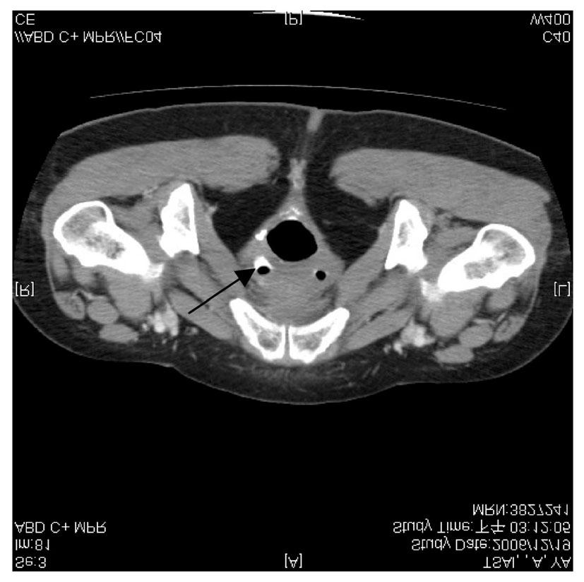Vol. 21, No. 3 Endoscopic Clipping of Rectovaginal Fistula 139 Fig. 1. Abdominal computed tomography (CT) revealed little air in vagina. Fig. 2. Single-contrast barium enema revealed a fistula tract from the middle rectum to the vagina.