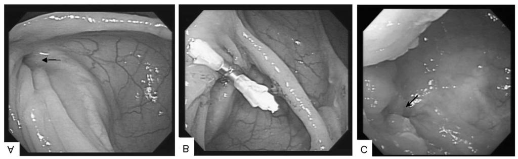 140 Hsin-Yuan Hung, et al. J Soc Colon Rectal Surgeon (Taiwan) September 2010 Fig. 3. (A) Colonoscopic examination showed a 6-mm hole at the middle rectum around the previous rectal anastomosis site.
