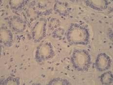 A) Karcinom s periglandularnim pukotinama (HEx400); B) Imunohistokemijski prikaz jako pozitivne reakcije (3+) u stromi