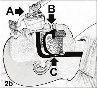 4 Sleep Disorders (a) (b) Figure 2: Fixed pressure delivered with a CPAP device (applied via a nasal soft-gel triangle mask) with the patient performing the Five- Minute CPAP Test using supine awake
