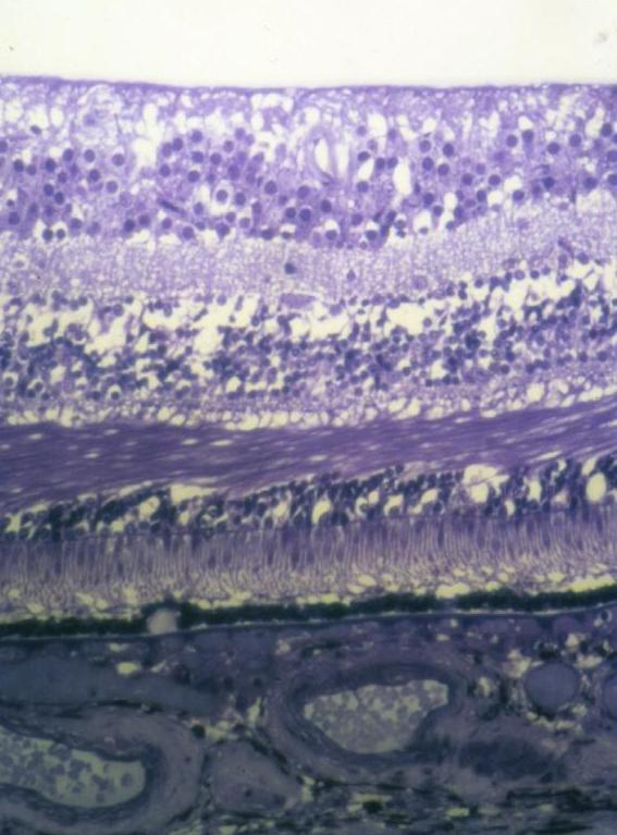 Typical retina Ganglion cell layer Bipolar cells Macula with top two layers pulled back to aid