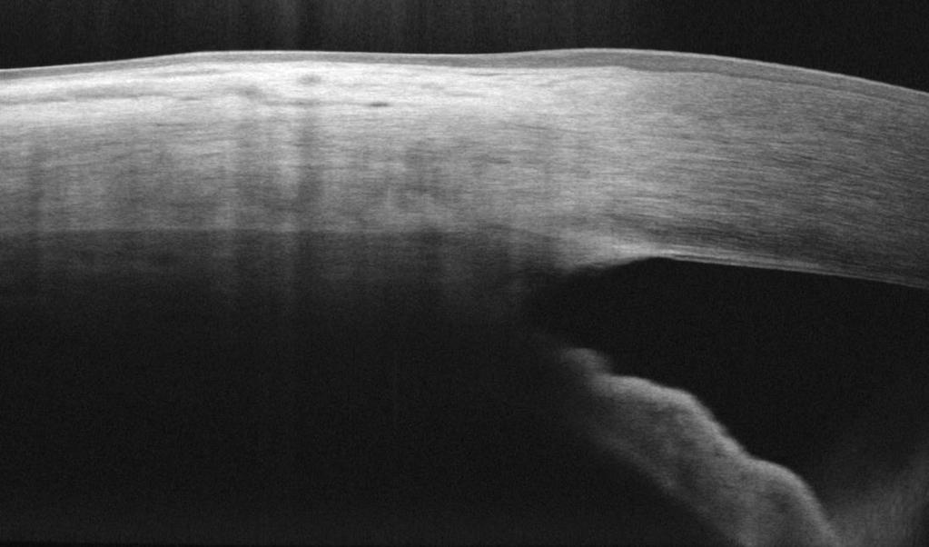 Anterior Segment Imaging Anterior Angle scan Epithelium