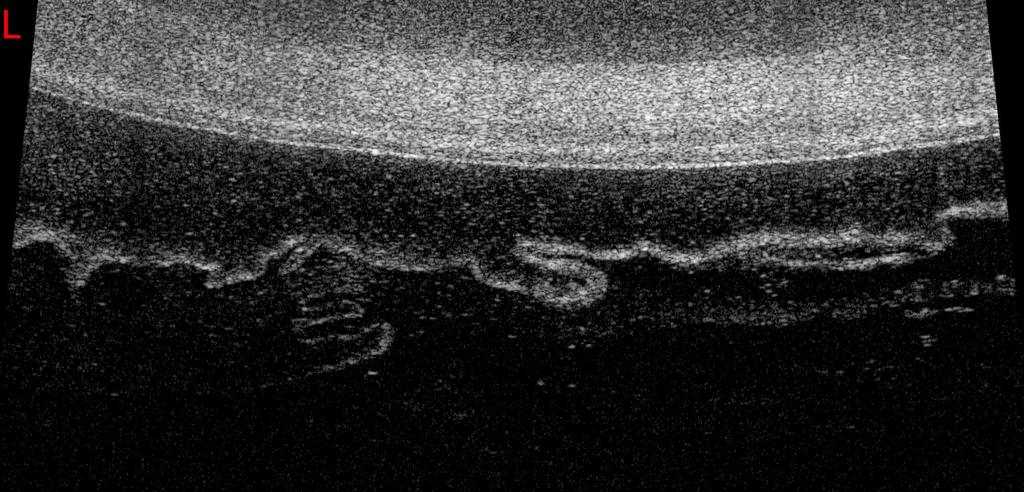 Anterior Segment Imaging Back of the crystalline Lens