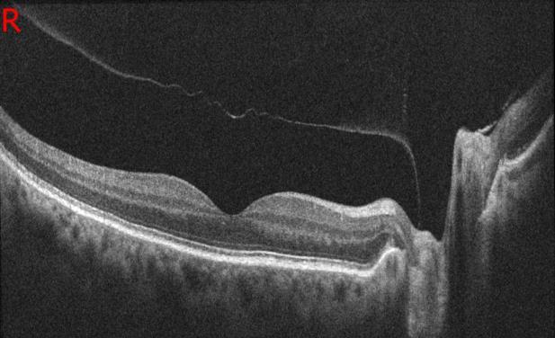 database Analysis program Retina Glaucoma Anterior Anterior - Angle to angle