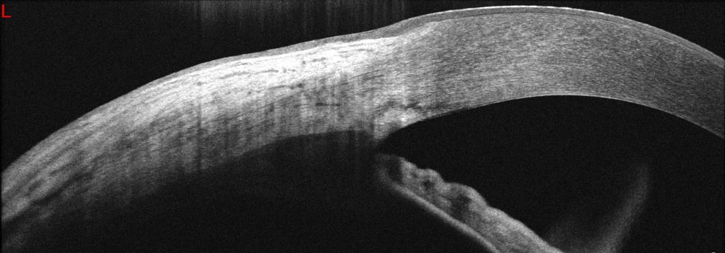 Wide Anterior Segment Imaging Sclera and Angle Structrure
