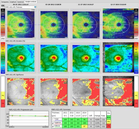 SOCT Copernicus REVO 8 retina layer recognition Examination review: o Single exam