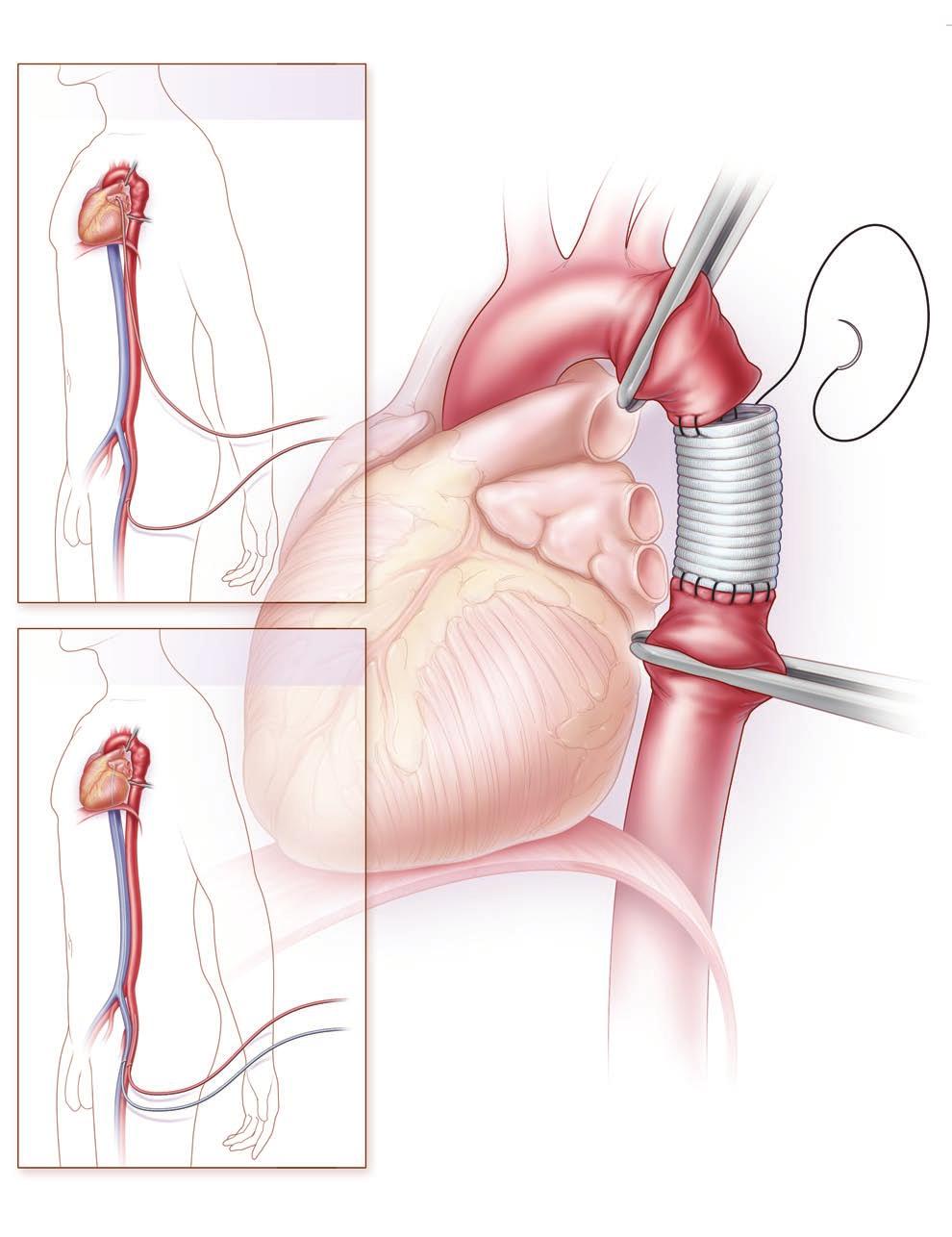 A Pulmonary vein to femoral-artery bypass Left atrium Aortic arch To pump From pump Open repair with interposition graft Femoral artery B Femoral venous femoral arterial cardiopulmonary bypass