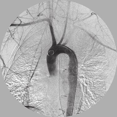 The new england journal of medicine A Patients with pelvic fractures may require angiographic embolization and can rebleed when positioned for a thoracotomy.