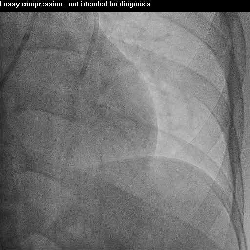 angiogram and