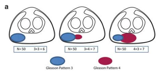 Genomic markers of aggressive disease in Gleason Pattern 3 tissue from Prostatectomy