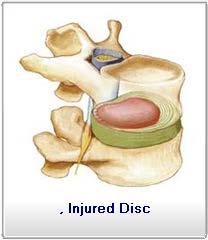 As the disc dehydrates and loses its ability to act like a sponge, small cracks or fissures start to appear in the outer layer of the disc.