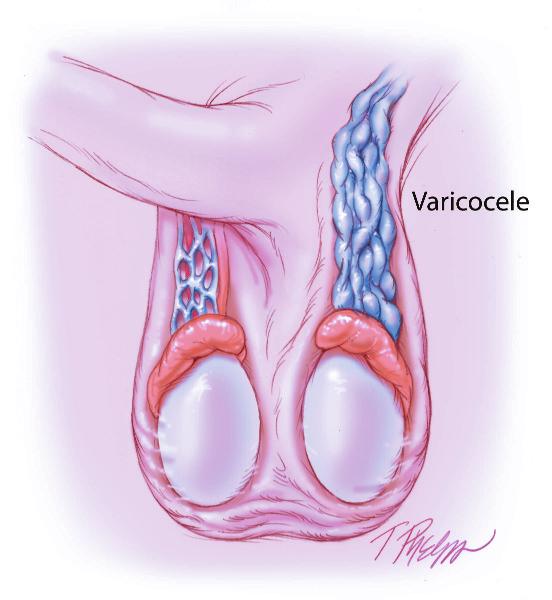 The Azoospermic Male spermatic cord. The Valsalva maneuver may aid in the identification of low-grade varicocele.
