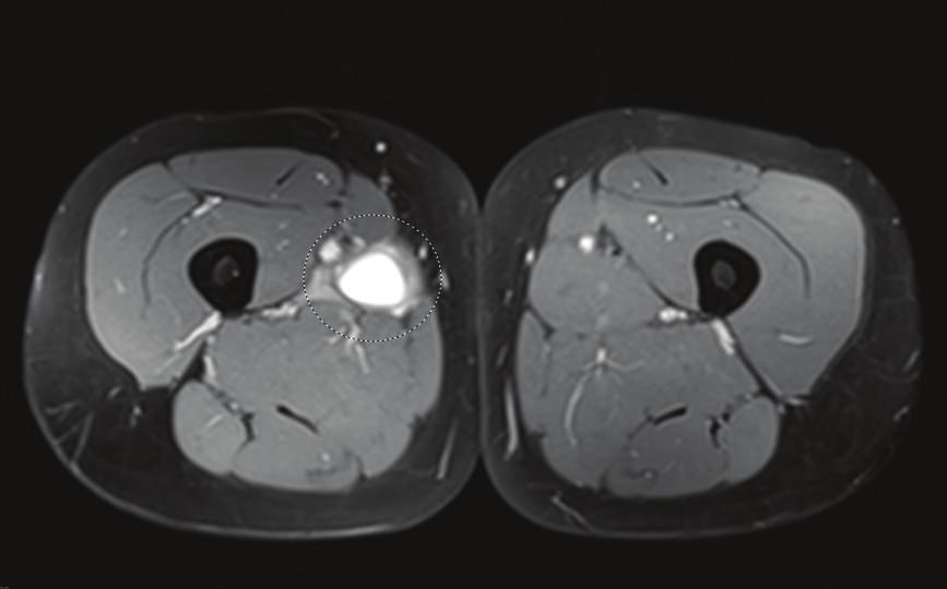 (b) T2-weighted coronal MRI image, additional to (a). Conservative treatment was started, consisting of a physiotherapy focused on stretching of the muscle followed by strength training.