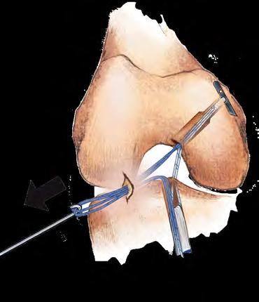11 Arthroscopic PCL Reconstruction Using Soft Tissue Graft with the ToggleLoc