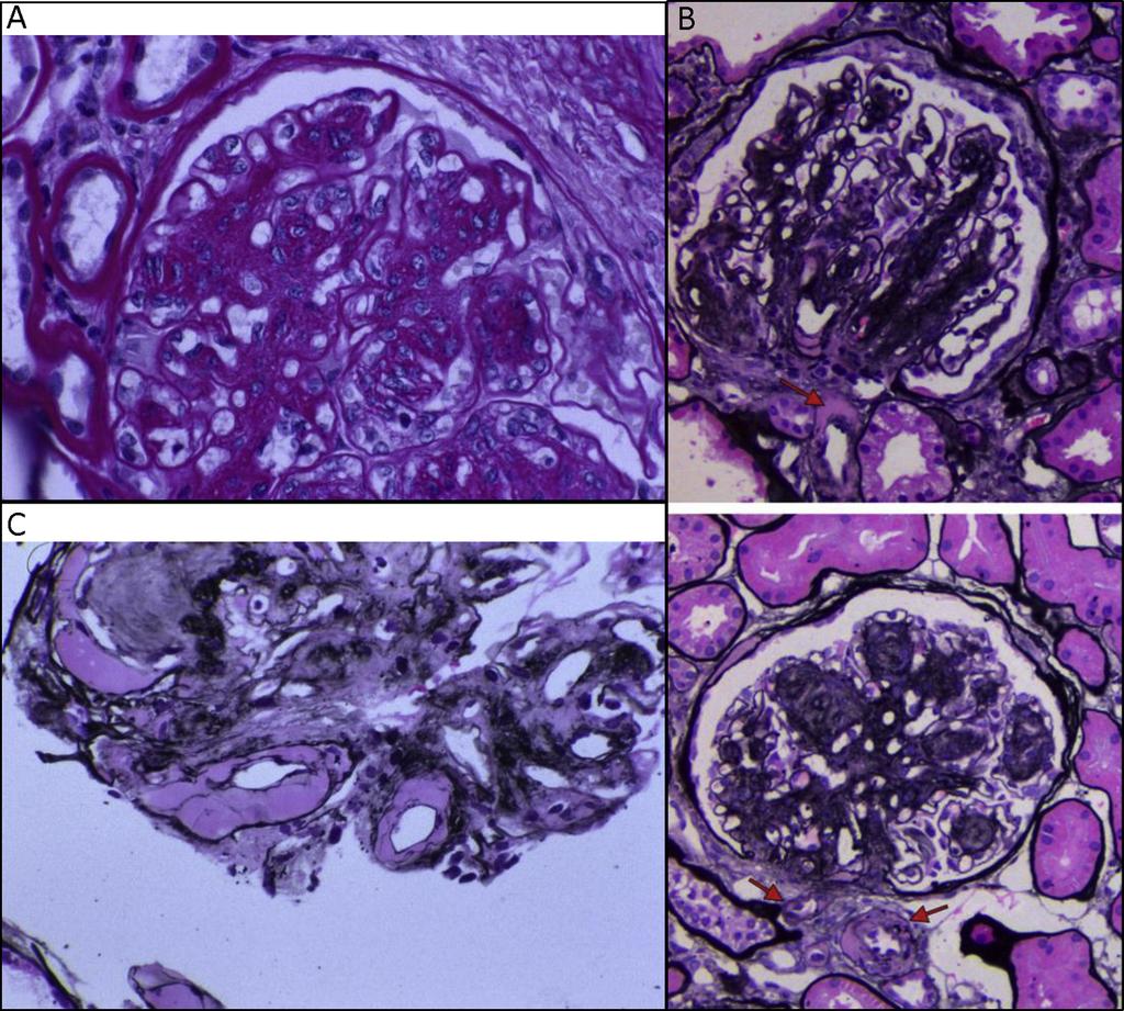 Figure 2. Kidney biopsy images of diabetic nephropathy.