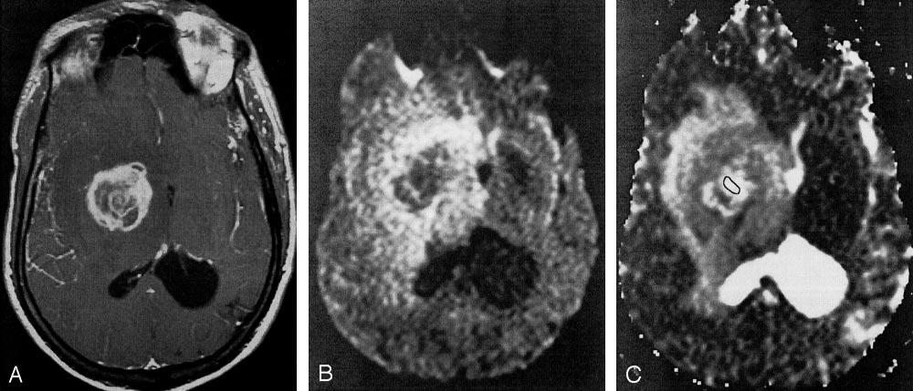 AJNR: 24, April 2003 BRAIN LESIONS IN AIDS 635 FIG 1. ADC ratios in toxoplasmosis and lymphoma lesions. Column heights and error bars represent the mean and SD, respectively.