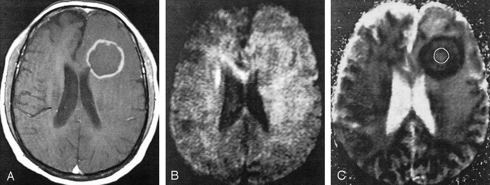636 CAMACHO AJNR: 24, April 2003 FIG 3. Axial images in an AIDS patient with lymphoma. A, Axial T1-weighted gadolinium-enhanced MR image.