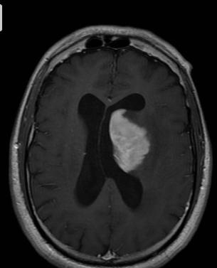 Clinical presentation Radiologic findings Toxoplasmosis Focal s/sx (~75%), HA (~50%), fever (~50%); sx evolve faster than CNSL At risk with CD4 count <200 Basal ganglia, thalamus, grey-white junction