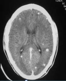 patients with subarachnoid disease.