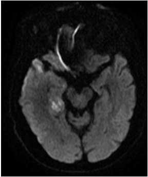 HSV-1 encephalitis Question: We have an inpatient who presented with 2 days
