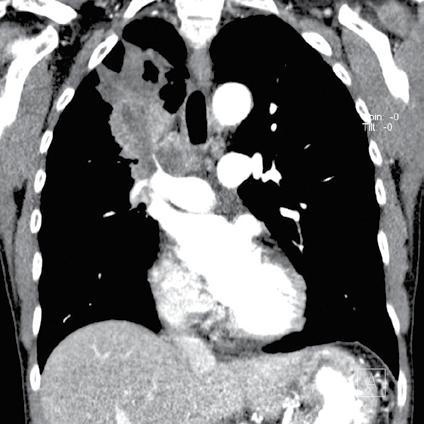 Embolism ICU Radiology Vascular and Non-vascular Trauma FDG-PET Imaging Thoracic MRI Dual Energy CT Radiation Dose Reduction Lung Cancer Screening, Staging, and Management Pulmonary Nodule Evaluation