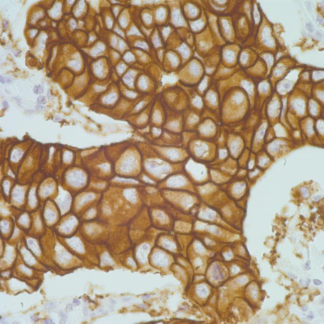 FIGURE 2. This photomicrograph reveals immunohistochemical staining for human epidermal growth factor receptor 2 (HER2) using HercepTest in an alcohol-fixed breast carcinoma cell block section.