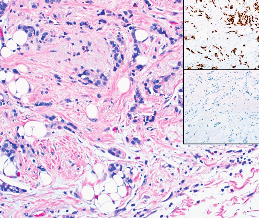 (H&E, immunohistochemistry 0; insets reduced to approximately 0% original size) Categorical difference was significantly associated with high grade in the largest focus and weak PR expression in any