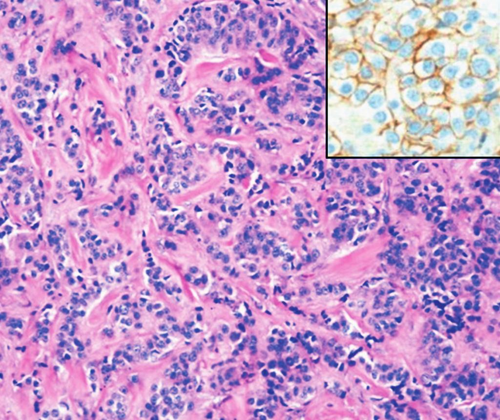 Case : focus (A), invasive ductal carcinoma () with (+) equivocal HER immunohistochemistry (IHC) and positive fluorescence in situ hybridization (FISH) (HER/D7Z ratio =.