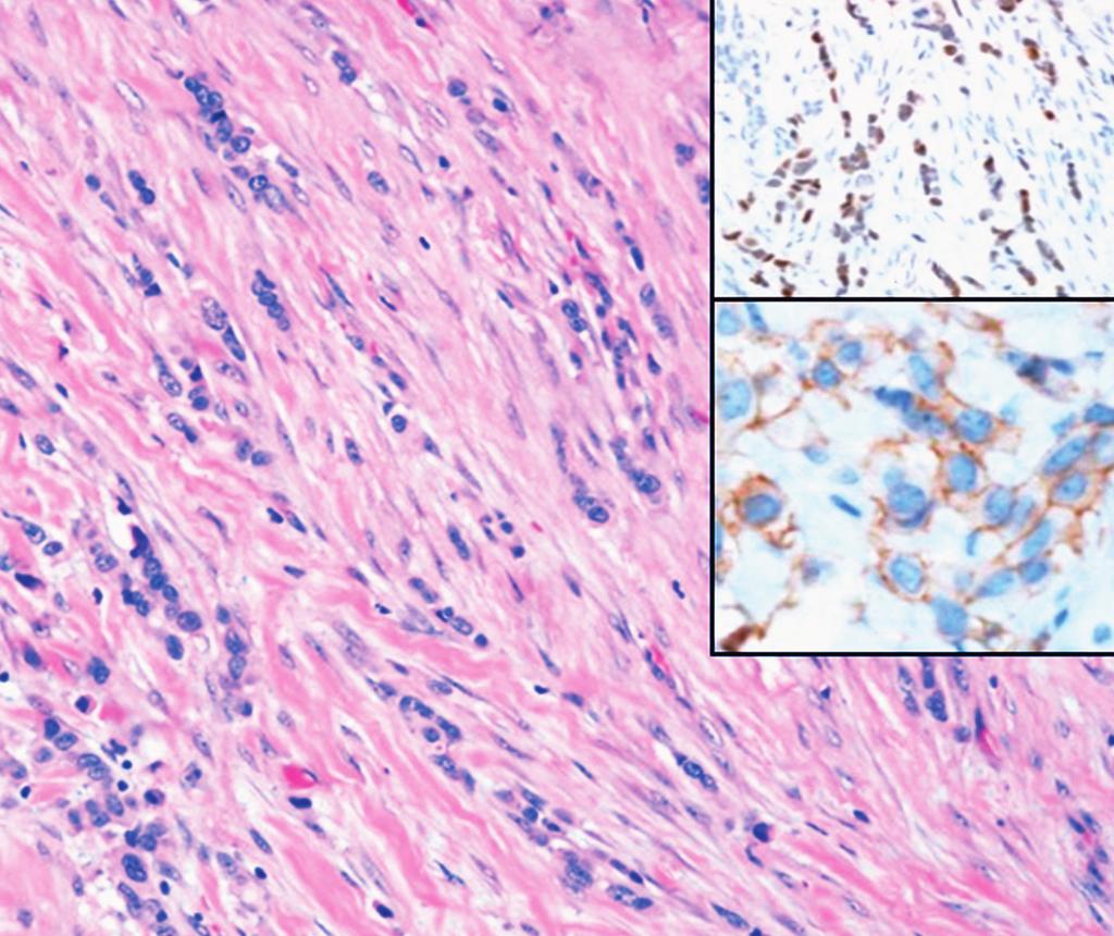 AJCP / Original Article C D E F Image (cont) Case : focus (C), invasive lobular carcinoma with positive ER and (+) equivocal HER IHC and focus (D), with negative ER and (+) positive HER IHC.