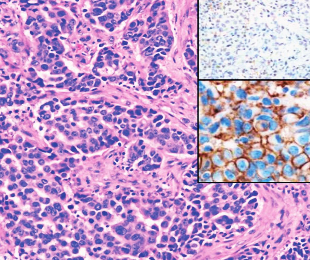In the study by Choi et al, all had different histology and were high grade, and three of four were of the same T stage.