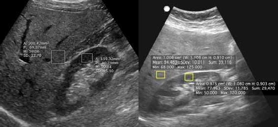 Results Image Measurements Hepatorenal indices There was significant discrepancy between hepatorenal indices calculated from images obtained using the telerobotic system as compared to the