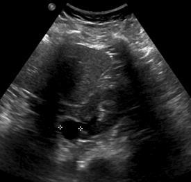 Imaging Findings Results Five pathological findings were identified on both examinations (two renal cysts, enlarged common bile duct, hepatic cyst,