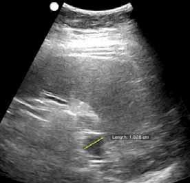 liver, and renal cyst) Two findings were identified only using telerobotic sonography (a renal cyst and gallbladder wall polyp).