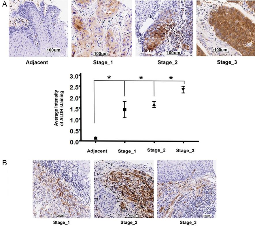 Figure 1. Immunohistochemical analysis of ALDH1A1 expression in esophageal cancer tissues. A. ALDH1A1 staining in esophageal cancer with different stages. B. ALDH1A1 staining in stromal cells.