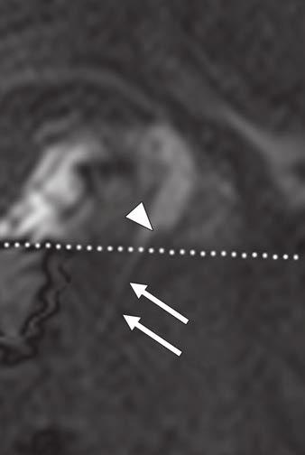 100.1 mm 3 /s), retrograde flow of bile (arrowhead, E) (bile flow