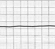 heartbeat ST elevation