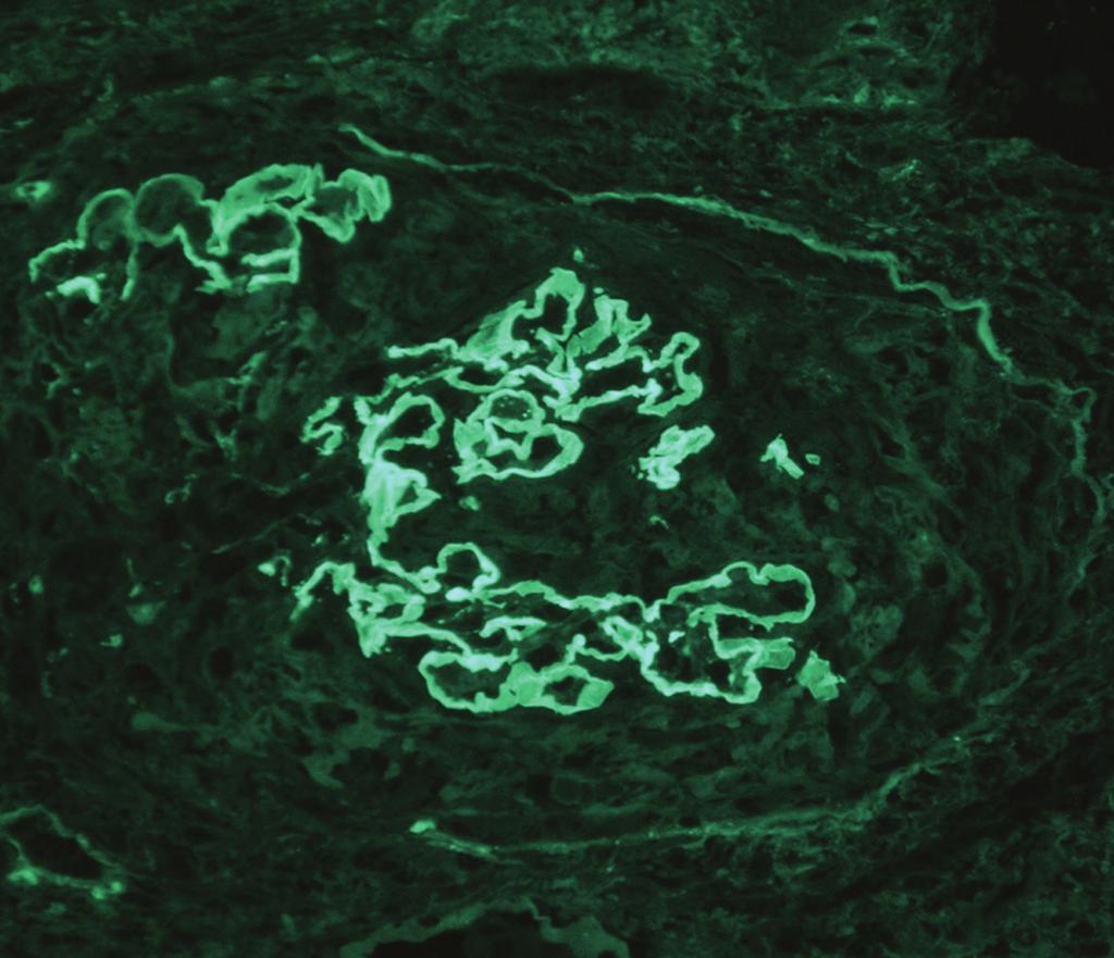 The capillary walls are disrupted focally due to crescent formation 250. (c) Broken glomerular capillary wall (arrow) associated with a cellular crescent.