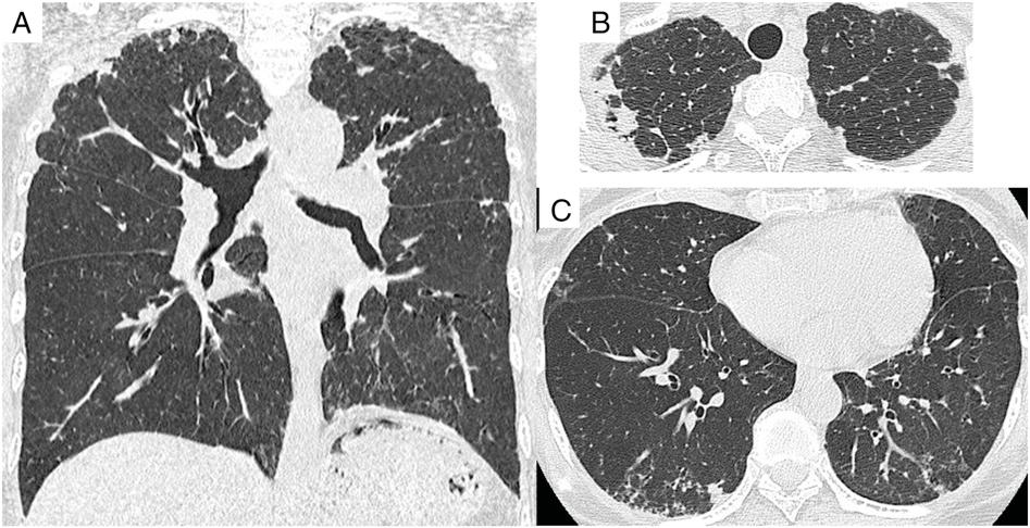 Figure 1 High-resolution CT imaging of patient 8, a 65-y-old woman. A, Coronal image showing bilateral, apical, irregular pleural thickening.