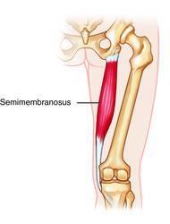 Origin: Ischial tuberosity Insertion: Semimembranosus (Part of the hamstrings) Medial condyle of