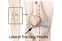 medialis Tight IT band or lateral