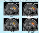 Impact of SUD in Juvenile BD MSIT: Multisource Interference Task HC: