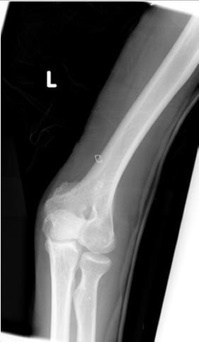 Elbow Burns Flexion contractures with forearm pronation common Risk of heterotopic ossification Heterotopic