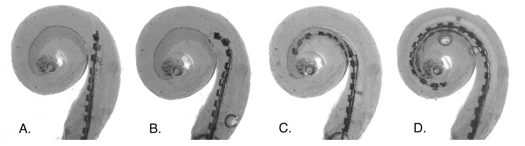 130 IEEE REVIEWS IN BIOMEDICAL ENGINEERING, VOL. 1, 2008 Fig. 17. Images illustrating the intended insertion path of a pre-molded spiral electrode using the AOS technique.